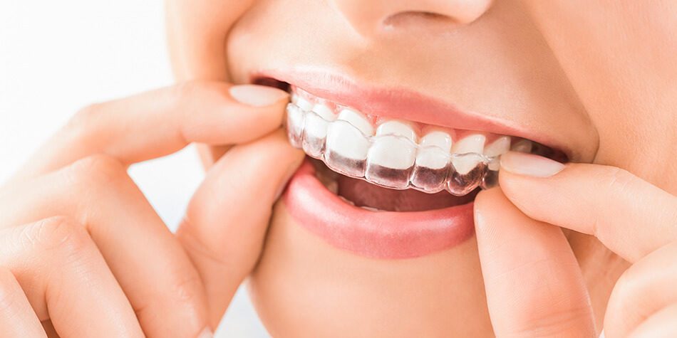 Facetas cerâmicas, lentes em resina e alinhadores, Invisalign ou